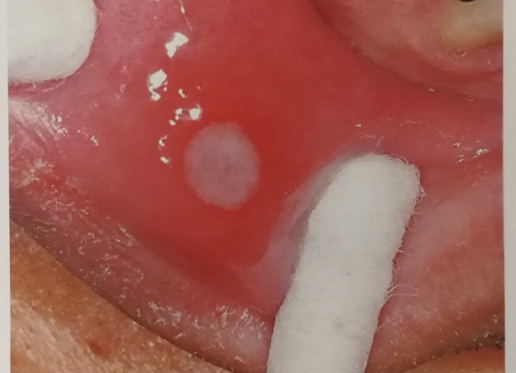 复发性口腔溃疡.jpg