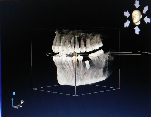 种植术后cbct.png
