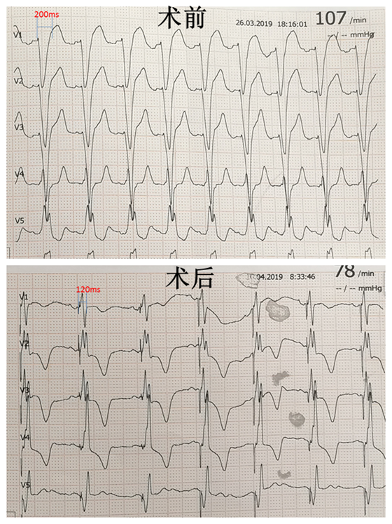 术后心电图_副本.png