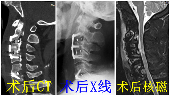 湘西北首例！湘雅常德医院自主完成首例ACAF手术
